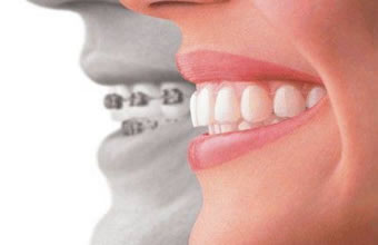 Sorriso Metálico - Foto 1